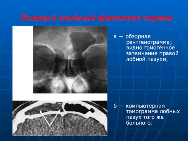 Острый гнойный фронтит справа а — обзорная рентгенограмма; видно гомогенное