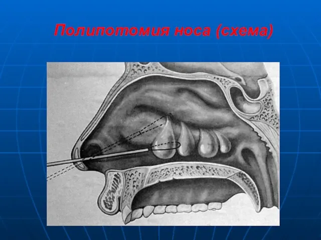 Полипотомия носа (схема)