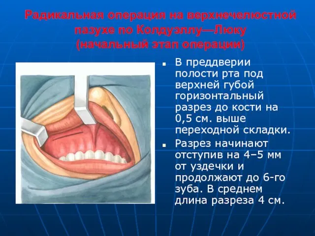 Радикальная операция на верхнечелюстной пазухе по Колдуэллу—Люку (начальный этап операции)