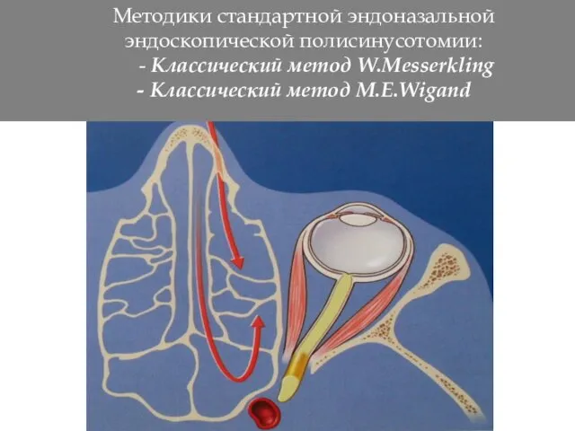 Методики стандартной эндоназальной эндоскопической полисинусотомии: - Классический метод W.Messerkling - Классический метод M.E.Wigand