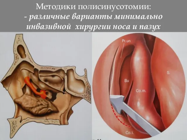 Методики полисинусотомии: - различные варианты минимально инвазивной хирургии носа и пазух