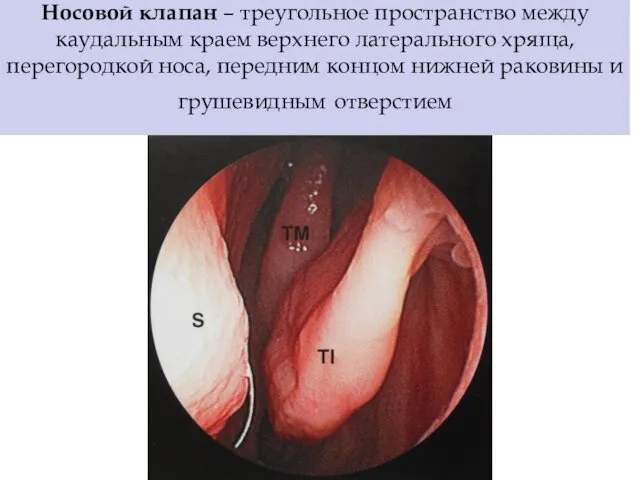 Носовой клапан – треугольное пространство между каудальным краем верхнего латерального