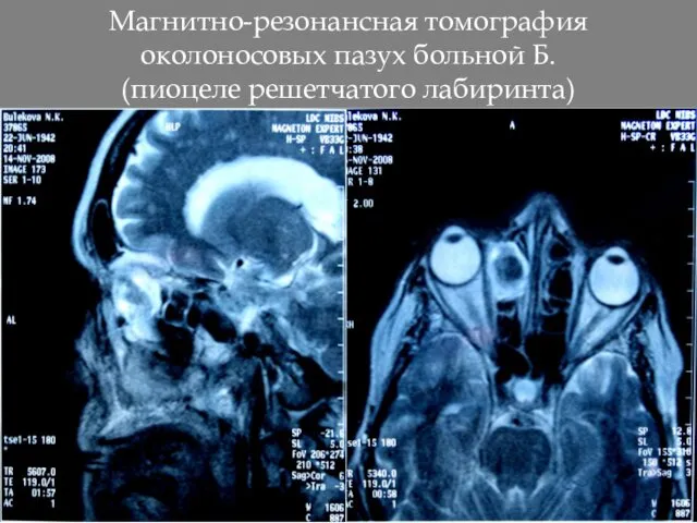 Магнитно-резонансная томография околоносовых пазух больной Б. (пиоцеле решетчатого лабиринта)