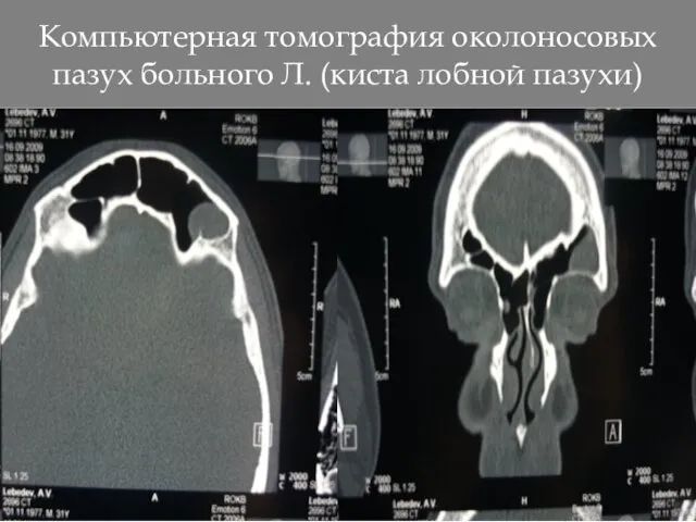 Компьютерная томография околоносовых пазух больного Л. (киста лобной пазухи)