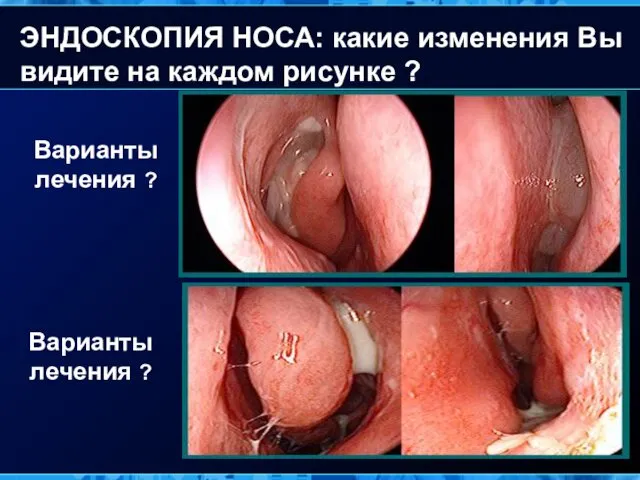 Варианты лечения ? Варианты лечения ? ЭНДОСКОПИЯ НОСА: какие изменения Вы видите на каждом рисунке ?