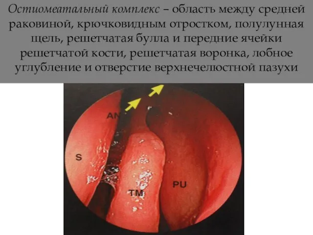 Остиомеатальный комплекс – область между средней раковиной, крючковидным отростком, полулунная