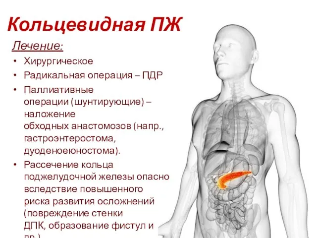 Кольцевидная ПЖ Лечение: Хирургическое Радикальная операция – ПДР Паллиативные операции