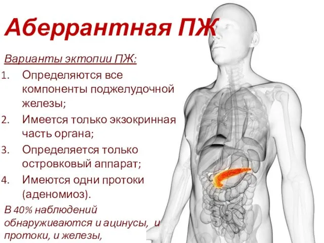 Аберрантная ПЖ Варианты эктопии ПЖ: Определяются все компоненты поджелудочной железы;