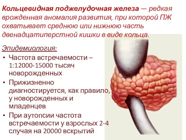 Кольцевидная поджелудочная железа — редкая врожденная аномалия развития, при которой