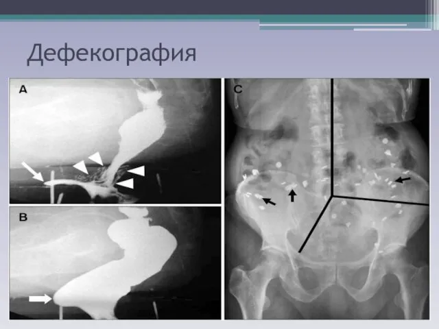 Дефекография