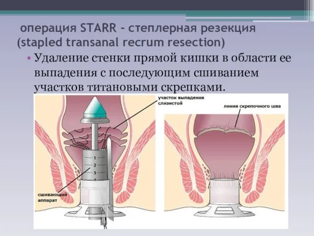 операция STARR - степлерная резекция (stapled transanal recrum resection) Удаление