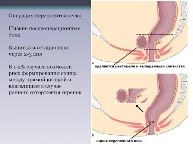 Операция переносится легко Низкие послеоперационные боли Выписка из стационара через