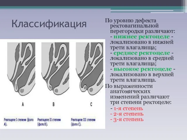 Классификация По уровню дефекта ректовагинальной перегородки различают: - нижнее ректоцеле