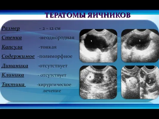 ТЕРАТОМЫ ЯИЧНИКОВ Размер - 2 - 12 см Стенка -неоднородная