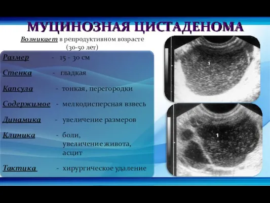 МУЦИНОЗНАЯ ЦИСТАДЕНОМА Возникает в репродуктивном возрасте (30-50 лет) Размер -