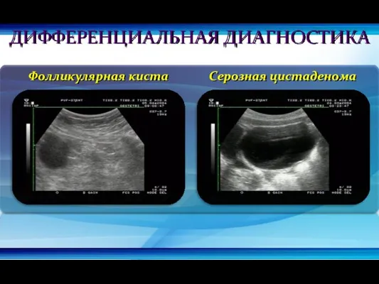 Фолликулярная киста Серозная цистаденома ДИФФЕРЕНЦИАЛЬНАЯ ДИАГНОСТИКА