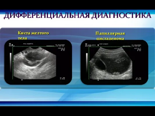 Киста желтого тела Папиллярная цистаденома ДИФФЕРЕНЦИАЛЬНАЯ ДИАГНОСТИКА