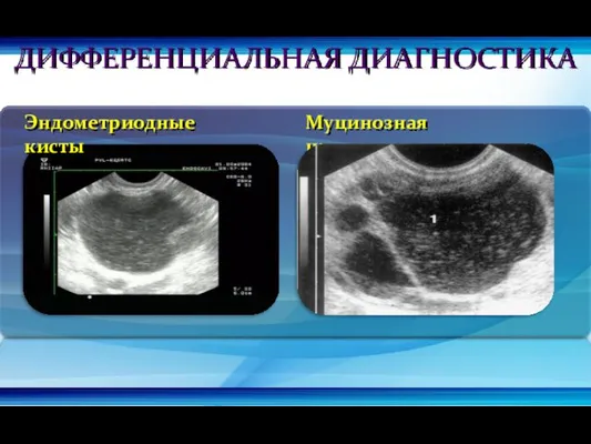 Муцинозная цистаденома Эндометриодные кисты ДИФФЕРЕНЦИАЛЬНАЯ ДИАГНОСТИКА