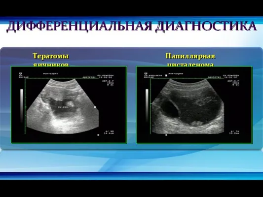 Тератомы яичников Папиллярная цистаденома ДИФФЕРЕНЦИАЛЬНАЯ ДИАГНОСТИКА