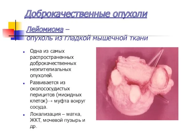 Доброкачественные опухоли Одна из самых распространенных доброкачественных неэпителиальных опухолей. Развивается