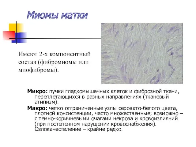 Миомы матки Микро: пучки гладкомышечных клеток и фиброзной ткани, переплетающихся