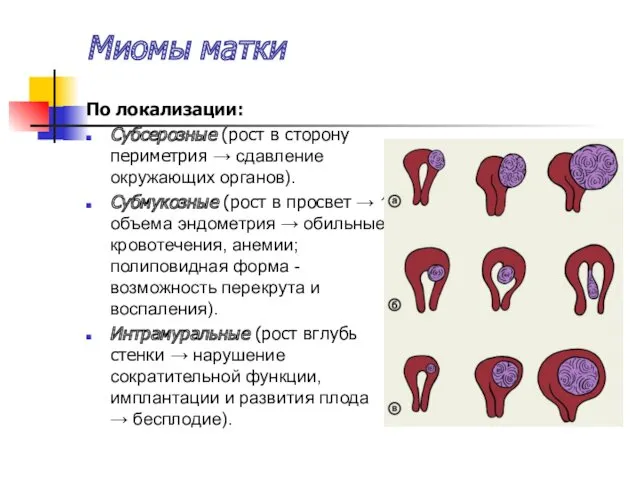 Миомы матки По локализации: Субсерозные (рост в сторону периметрия →