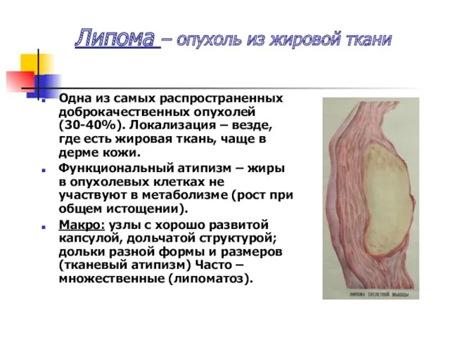 Липома – опухоль из жировой ткани Одна из самых распространенных