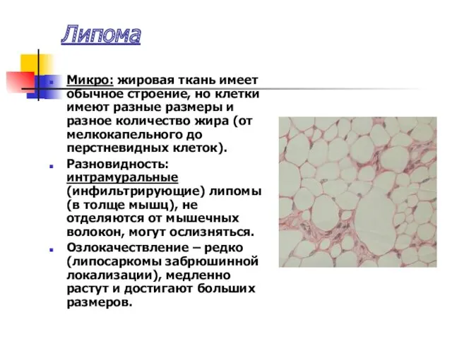 Липома Микро: жировая ткань имеет обычное строение, но клетки имеют