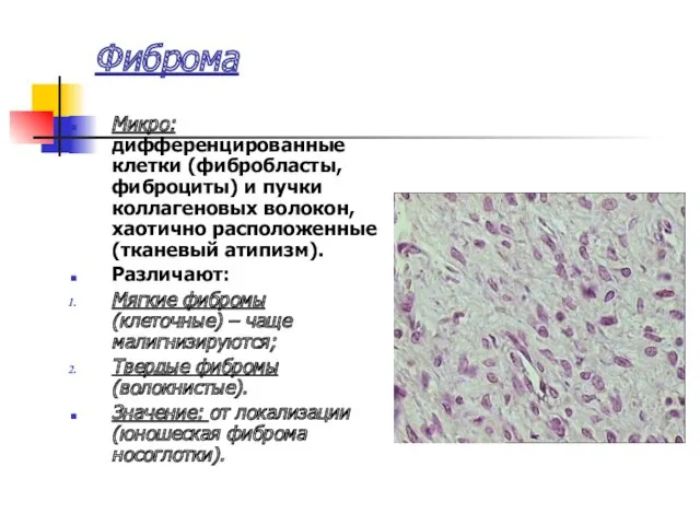 Фиброма Микро: дифференцированные клетки (фибробласты, фиброциты) и пучки коллагеновых волокон,