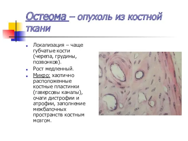 Остеома – опухоль из костной ткани Локализация – чаще губчатые