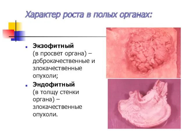 Характер роста в полых органах: Экзофитный (в просвет органа) –