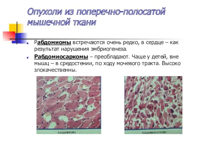 Опухоли из поперечно-полосатой мышечной ткани Рабдомиомы встречаются очень редко, в