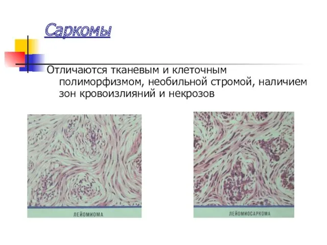 Саркомы Отличаются тканевым и клеточным полиморфизмом, необильной стромой, наличием зон кровоизлияний и некрозов