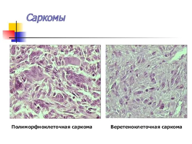 Саркомы Полиморфноклеточная саркома Веретеноклеточная саркома