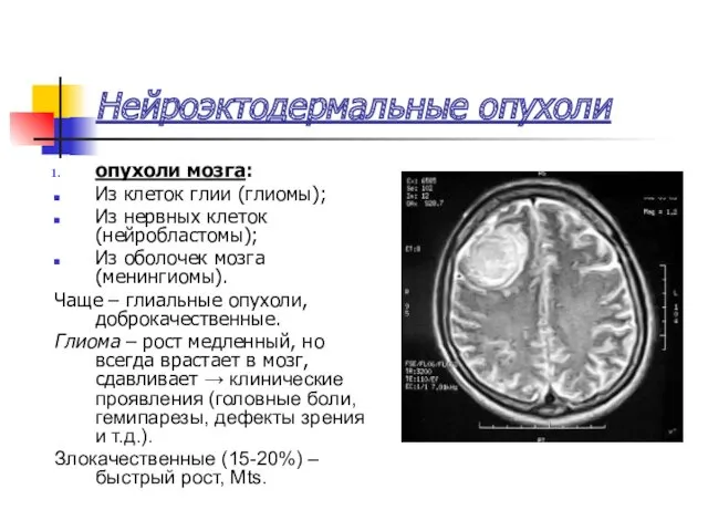 Нейроэктодермальные опухоли опухоли мозга: Из клеток глии (глиомы); Из нервных
