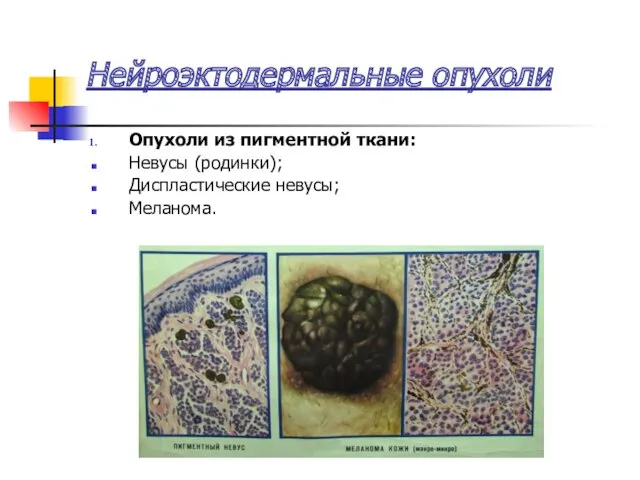 Нейроэктодермальные опухоли Опухоли из пигментной ткани: Невусы (родинки); Диспластические невусы; Меланома.