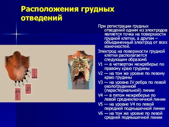 Расположения грудных отведений При регистрации грудных отведений одним из электродов