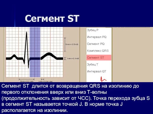 Сегмент ST Сегмент ST длится от возвращения QRS на изолинию до первого отклонения