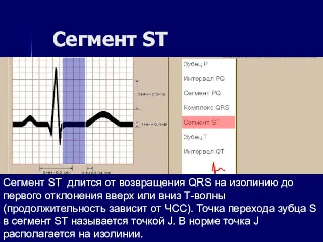 Сегмент ST Сегмент ST длится от возвращения QRS на изолинию