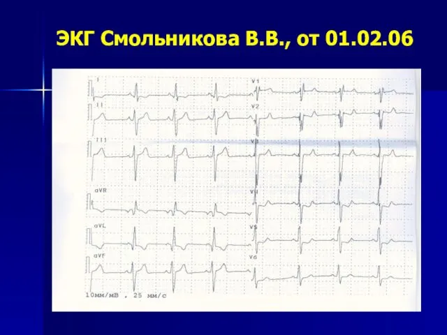 ЭКГ Смольникова В.В., от 01.02.06