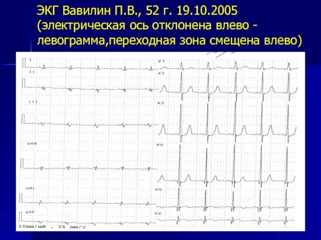 ЭКГ Вавилин П.В., 52 г. 19.10.2005 (электрическая ось отклонена влево -левограмма,переходная зона смещена влево)