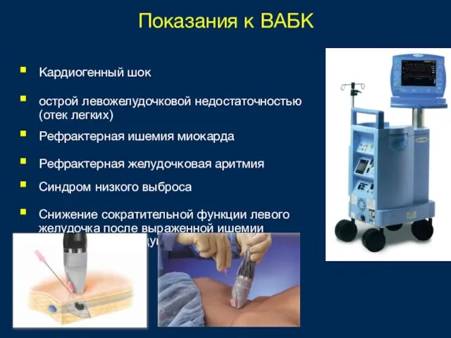 Показания к ВАБК Кардиогенный шок острой левожелудочковой недостаточностью (отек легких) Рефрактерная ишемия миокарда