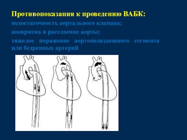 Противопоказания к проведению ВАБК: недостаточность аортального клапана; аневризма и расслоение аорты; тяжелое поражение