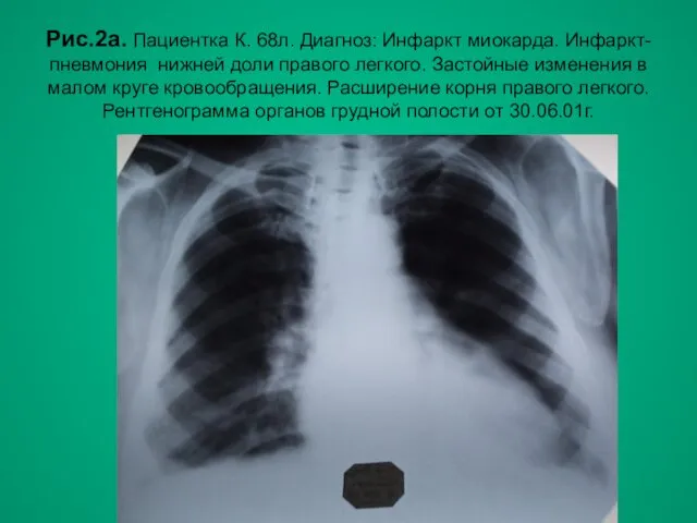 Н.С. Воротынцева, С.С. Гольев Рентгенопульмонология Рис.2а. Пациентка К. 68л. Диагноз:
