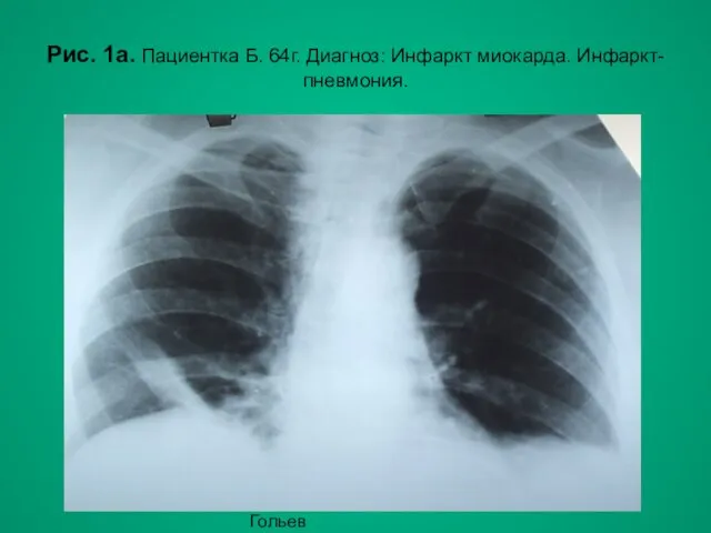 Н.С. Воротынцева, С.С. Гольев Рентгенопульмонология Рис. 1а. Пациентка Б. 64г. Диагноз: Инфаркт миокарда. Инфаркт-пневмония.
