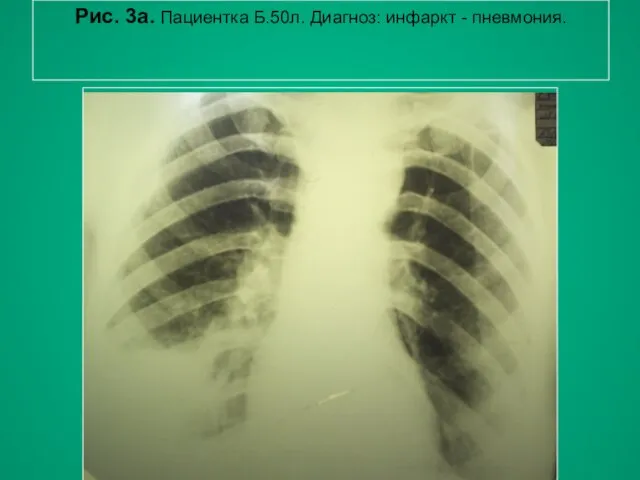 Н.С. Воротынцева, С.С. Гольев Рентгенопульмонология Рис. 3а. Пациентка Б.50л. Диагноз: инфаркт - пневмония.