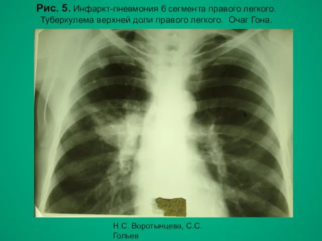 Н.С. Воротынцева, С.С. Гольев Рентгенопульмонология Рис. 5. Инфаркт-пневмония 6 сегмента