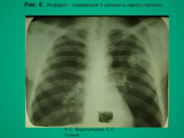 Н.С. Воротынцева, С.С. Гольев Рентгенопульмонология Рис. 6. Инфаркт - пневмония 3 сегмента левого легкого.