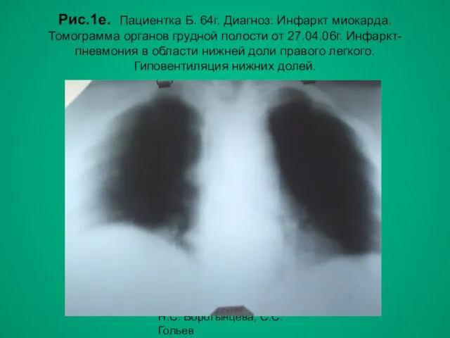 Н.С. Воротынцева, С.С. Гольев Рентгенопульмонология Рис.1е. Пациентка Б. 64г. Диагноз: