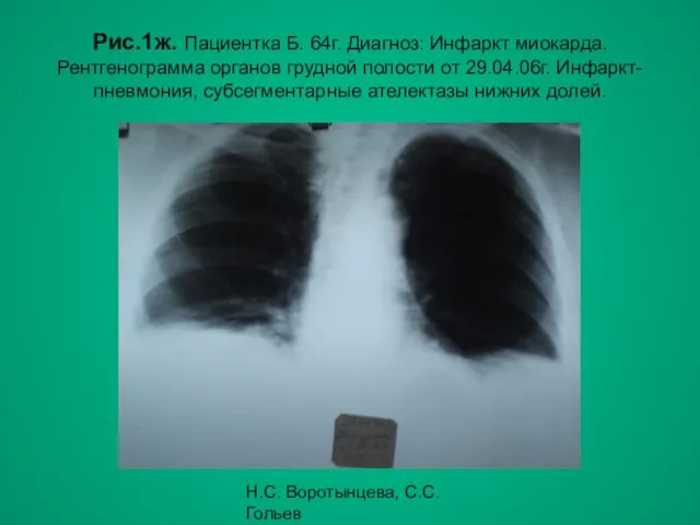 Н.С. Воротынцева, С.С. Гольев Рентгенопульмонология Рис.1ж. Пациентка Б. 64г. Диагноз:
